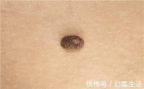 皮肤|皮肤上的痣发生这些变化, 还请尽快去医院找医生就诊!