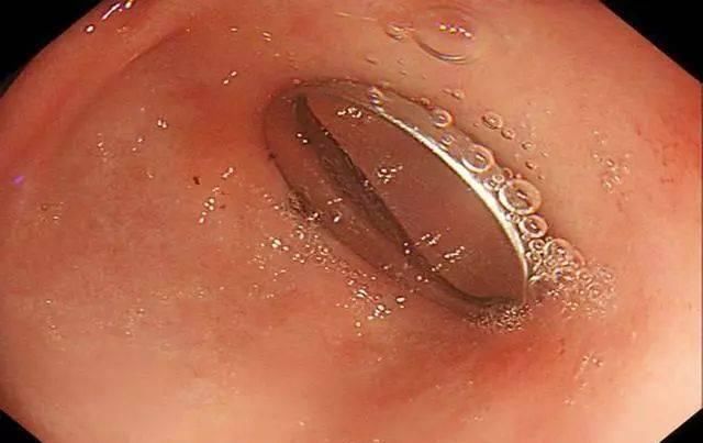 入院|5岁宝宝误吞磁力球入院，医生提醒这些东西很危险趁早全部扔掉