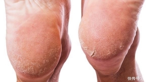 皮肤病|为什么中老年人脚后跟会出现干裂多跟3种疾病有关,别不在意