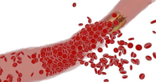 血压|血压高到什么程度时，容易发生脑出血预防脑出血要注意的4点