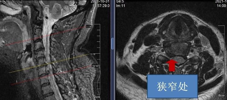 刘大姐|7mm的钥匙孔手术，解决颈椎病大难题