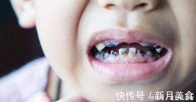 父母|3岁儿子满口“小黑牙”,罪魁祸首不是糖果,而是父母的无知