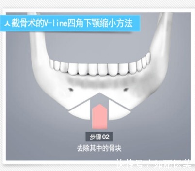 操作方法 下巴截骨术危险吗?手术注意事项须知及术后怎么护理?看完全明白了!