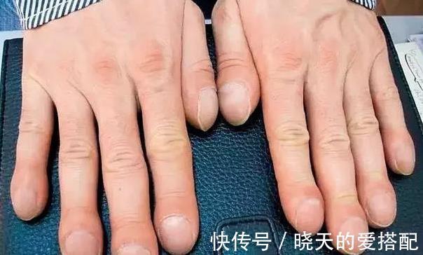 肚回弹|46岁男子,不痛不痒,查出肺癌,手上1个异常,提示已到中晚期!