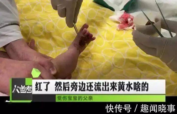截肢|2个月宝宝险被截肢,每小时放一次血!凶手竟是妈妈一根头发