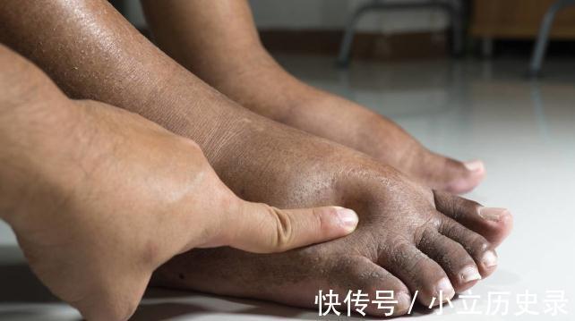 并发症|糖尿病患病多久会出现并发症?各种并发症来临前都会有哪些症状?