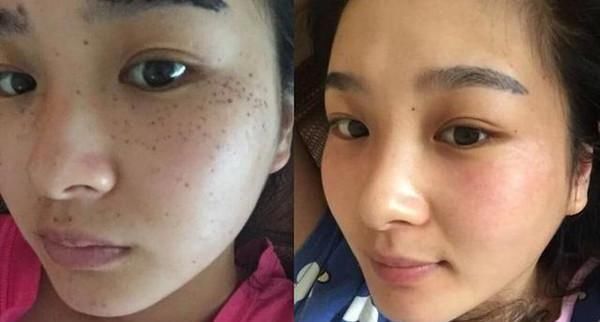 红霉素软膏加一物敷脸,15天美白肌肤淡化色斑,赶紧去备上一支