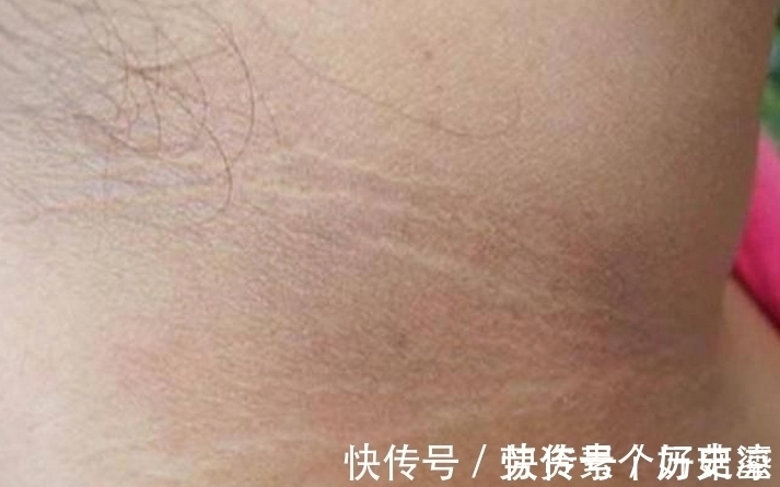 婷婷|6岁小女孩脖颈发黑洗不掉,去医院做检查,医生的话让妈妈笑了