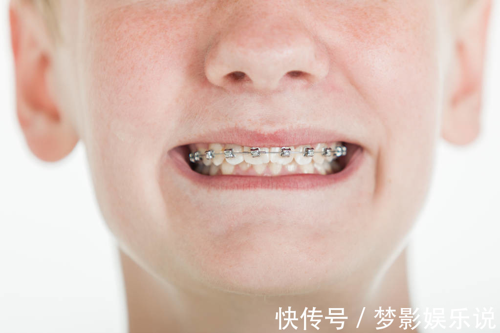 矫正|儿童做牙齿矫正三个最佳时间:家长要牢记,矫治越早干预效果越好