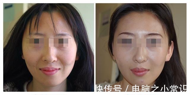 高光点 都说做拉皮手术不能太早,可我还是动心了!