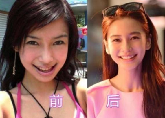 牙齿|有种“整容”叫傅园慧,整牙前后判若两人:被严重低估的颜值