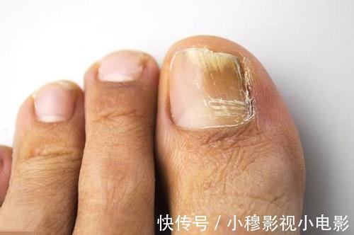 掌心|肝癌多是“拖”出来的，如果双脚有4种迹象，趁早就医，能保命！