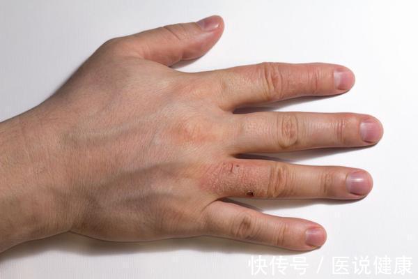 水泡|手上莫名长小水泡,又痒又痛,尽量做好这4点,或能帮你缓解