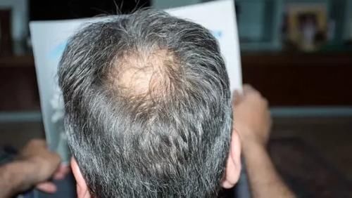 生活习惯|什么洗发水生发效果最好？一款专治脱发的洗发水!