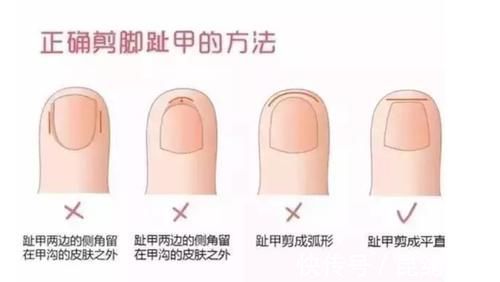 指甲缝|指甲其实是要成方的?剪了这么多年指甲,你可能都用错了方法!