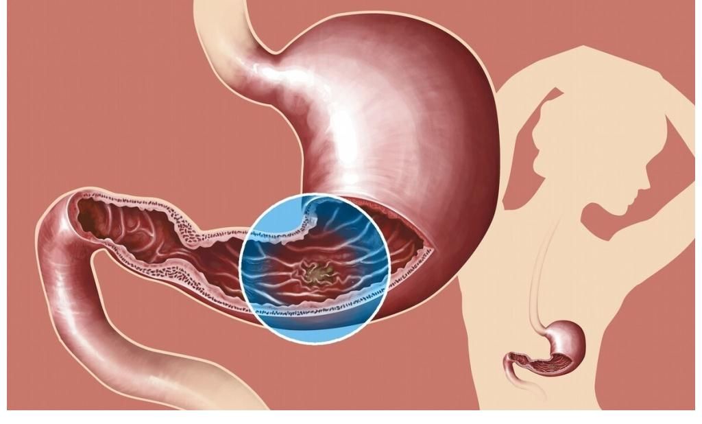 胃痛|55岁阿姨胃痛晕倒，查出胃癌，医生直言：1种水果别傻傻当成宝了