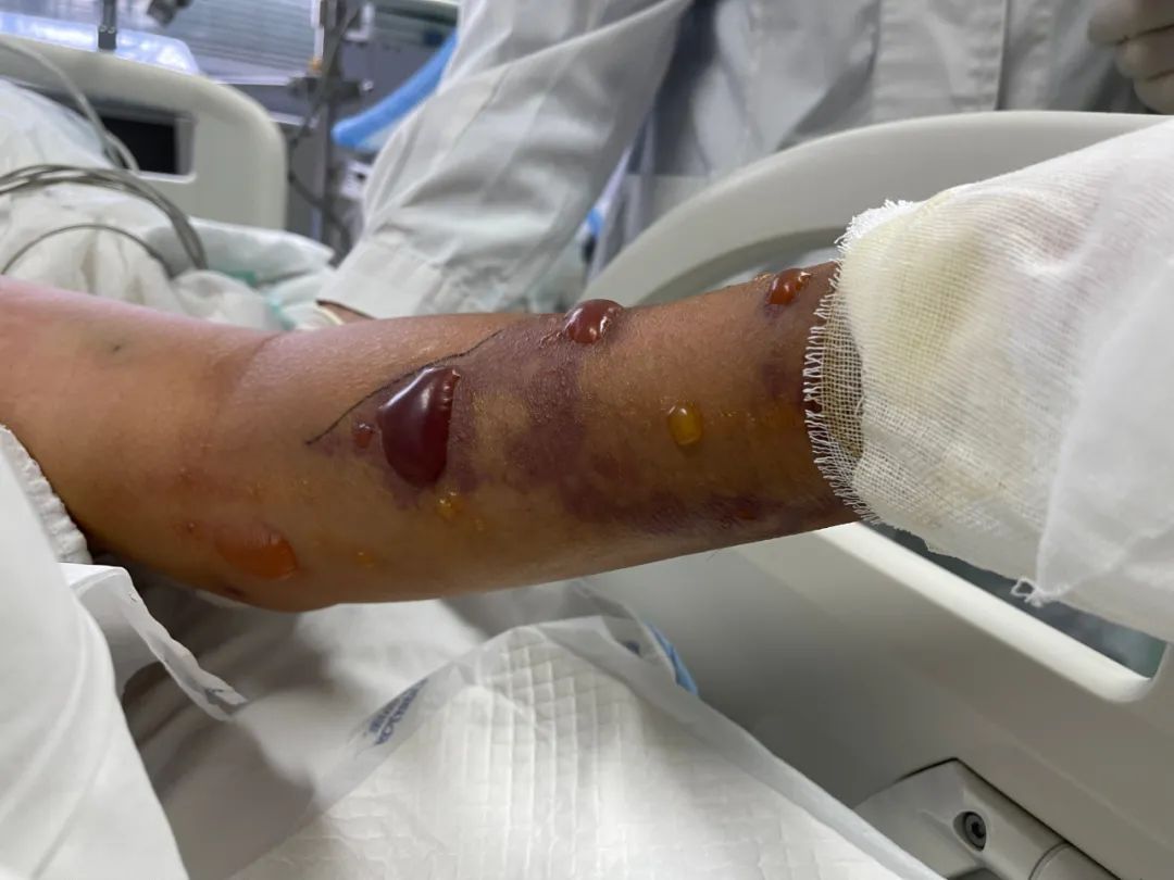 感染性休克|老人洗了一条鱼,竟然进了ICU!医生:“立即截肢,否则性命不保!”