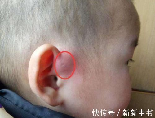 沙土堆|你家宝宝耳朵上有“富贵洞”吗?如果有,家长们可要多留心了