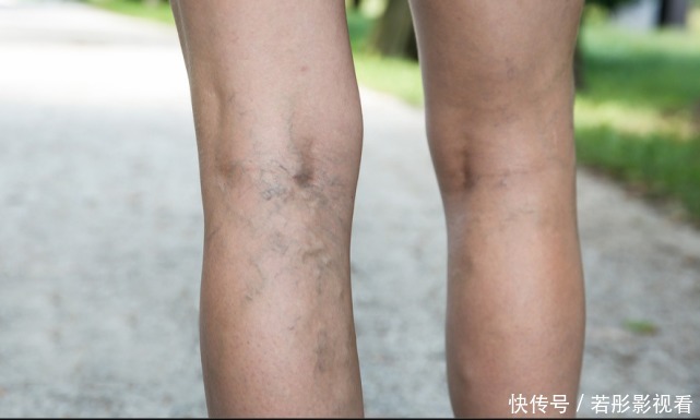 远离血栓,请记住,晨起两坚持,晚上两不要,血管才会更通畅