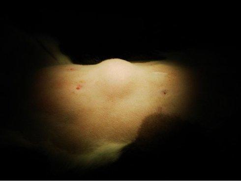 小方子|治“脂肪瘤”的小方子来了！偷学来的险招，治疙瘩不痛、不痒