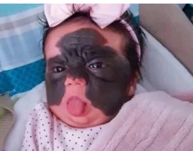 整容|“蝙蝠侠宝宝”火了,美国夫妇将她送去整容祛除胎记,后来怎么样