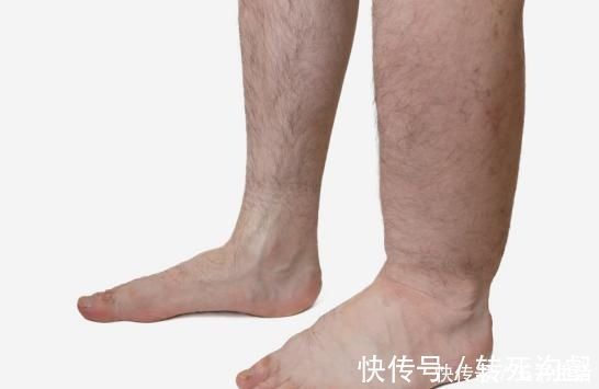 胸闷|“溶栓高手”找到了，不是木耳，没事敞开喝，血栓悄悄地不见了