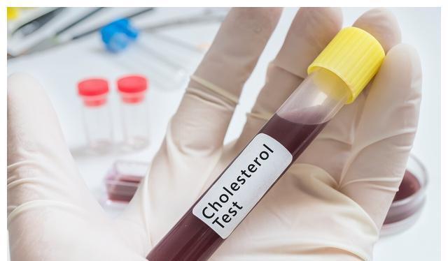 心血管疾病|不吃药，真能降血脂吗？医生确认了：能！但要认准这2种高血脂