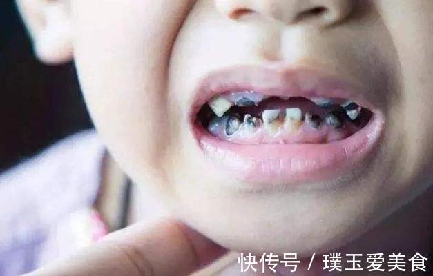 牙齿|为什么越来越多孩子满口黑牙?主因不是糖果,而是无知的父母