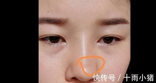 整形手术|女子花了4万做整容,鼻子却留下一个坑?美容院:术前已告知风险