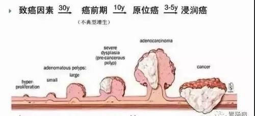 肠息肉是大肠癌的前身，有办法预防吗？