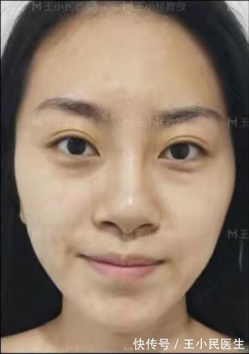 线雕 王小民教授:当面部早衰了,适合做小拉皮吗?看看她的变化!