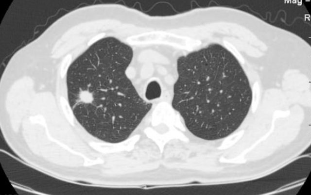 身体健康|晚上睡觉出现3种现象，或是肺部结节症状，为了身体健康也要了解
