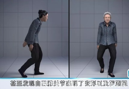 要点|全膝关节置换靠谱不？能用多长时间？祥和骨外科专家为你剖析