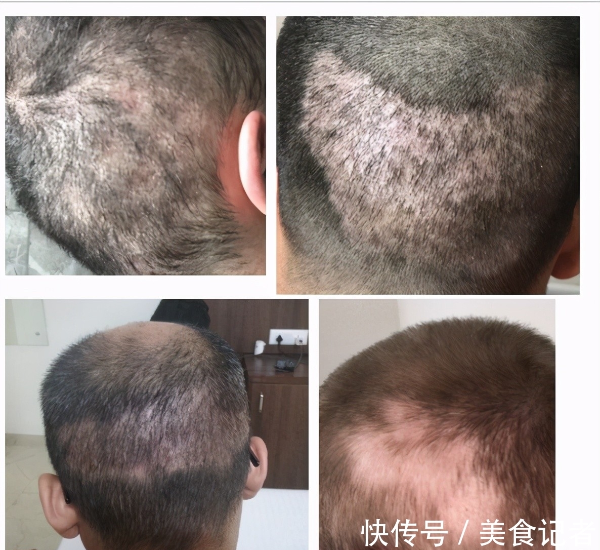 chris 每个月到底有多少人去土耳其植发？