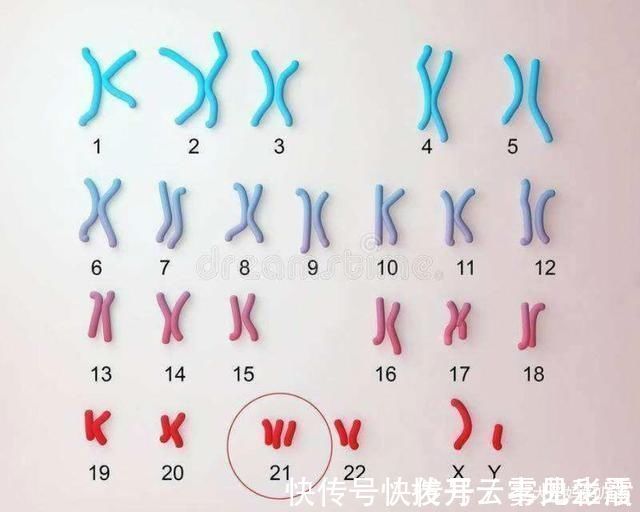 新生儿|有“唐氏综合征”的孩子，面部是什么样子？婴儿期能看出来吗