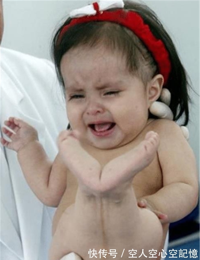 早夭|美国女孩出生患美人鱼症,喜欢在水里,生存十年创造医学奇迹