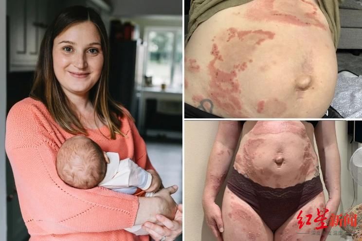 免疫性|这位英国妈妈竟对自己的娃严重过敏，怀孕期间全身布满水泡疤痕