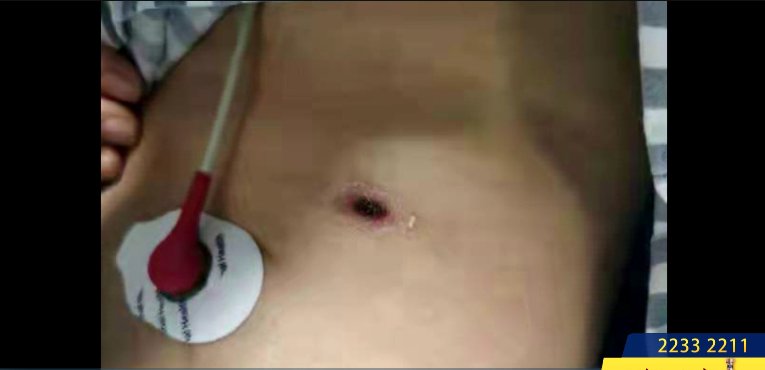 王妍|女子呼吸衰竭至今仍住ICU！罪魁祸首令人心惊