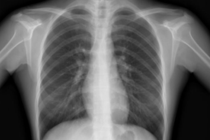 ct|肺结节是不是肺癌？影像检查该做哪个？