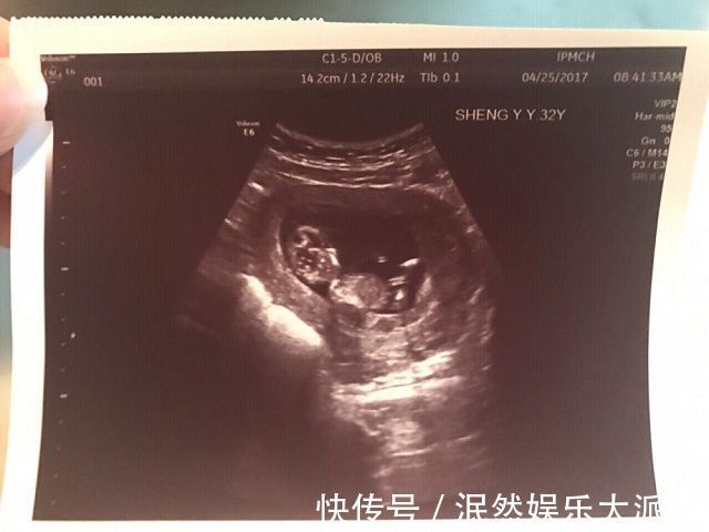 染色体|孕期第几周能看出“胎儿性别”这个时间段,B超医生一眼能看出
