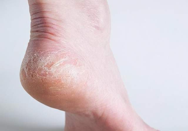 a300|血糖高的人,脚上会出现3种变化,哪怕占一个,也要检查一下血糖