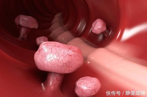 肠息肉|两种息肉一旦发现,最好及时切除,一拖再拖会变成癌症