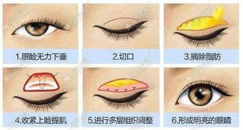 提眉可以改善上睑下垂的问题吗？