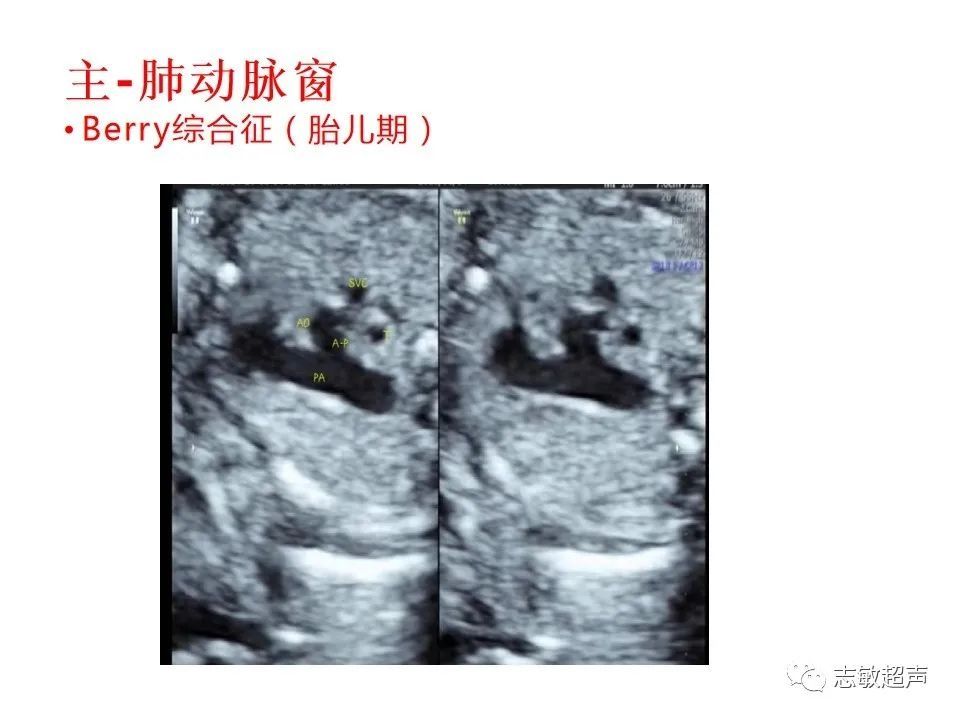 超声|肺动脉瓣周边异常血流的超声鉴别