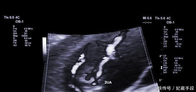 打嗝|孕期肚子“一跳一跳”是怎么回事若以为胎动的话,那你可能错了