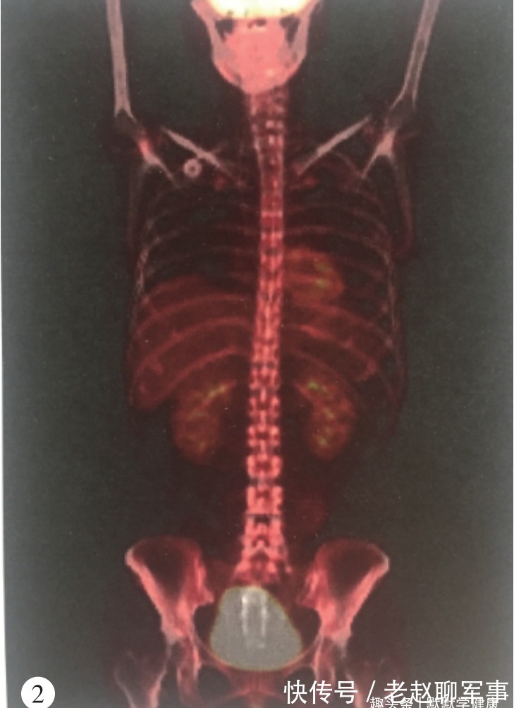 乐启生|48岁确诊乳腺癌晚期,从逃避到重生,8年时间她总结出抗癌秘诀
