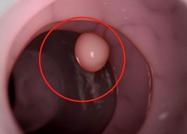 小突起|不论男女，身上若没3个“小突起”，恭喜，癌细胞可能不喜欢你