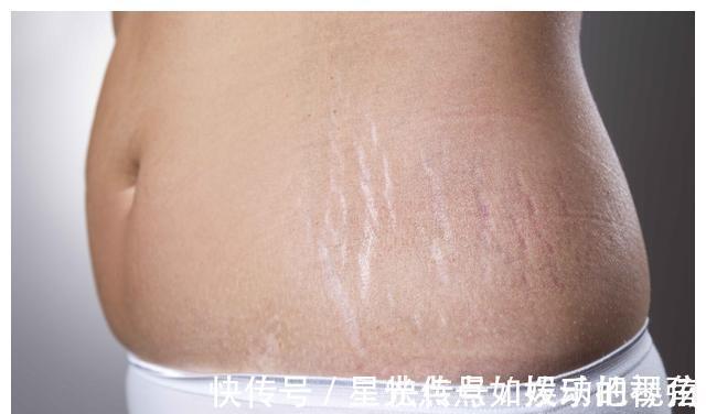 孕妇|女人如果多次剖腹产,肚子会变成什么样?看完觉得“头皮发麻”