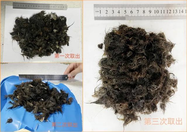 肠梗阻|18岁女孩胃内惊现毛发结石"硬家伙"