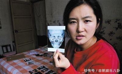 维权|劝你别割“双眼皮”,整容师透露3点,割过的人很后悔